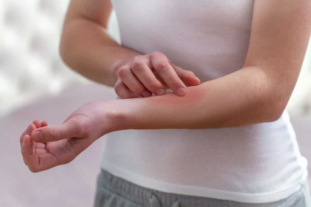 Verlichten van atopisch eczeem met visolie supplementen