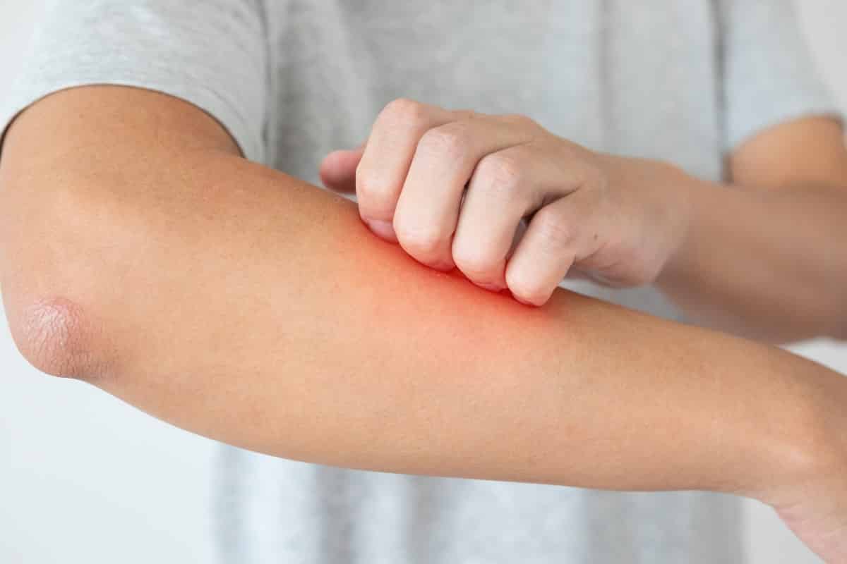 Een voedselallergie kent verschillende klachten Klachten voedselallergieën