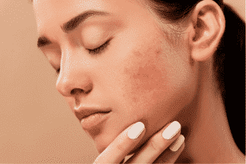 zink ondersteunt de vermindering van acne