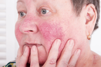 rosacea komt vooral bij vrouwen vanaf 30 jaar voor