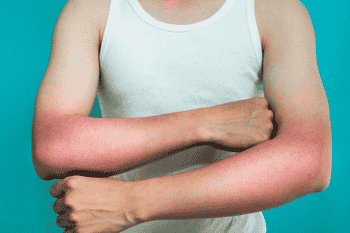 zonneallergie veroorzaakt rode plekken en jeuk