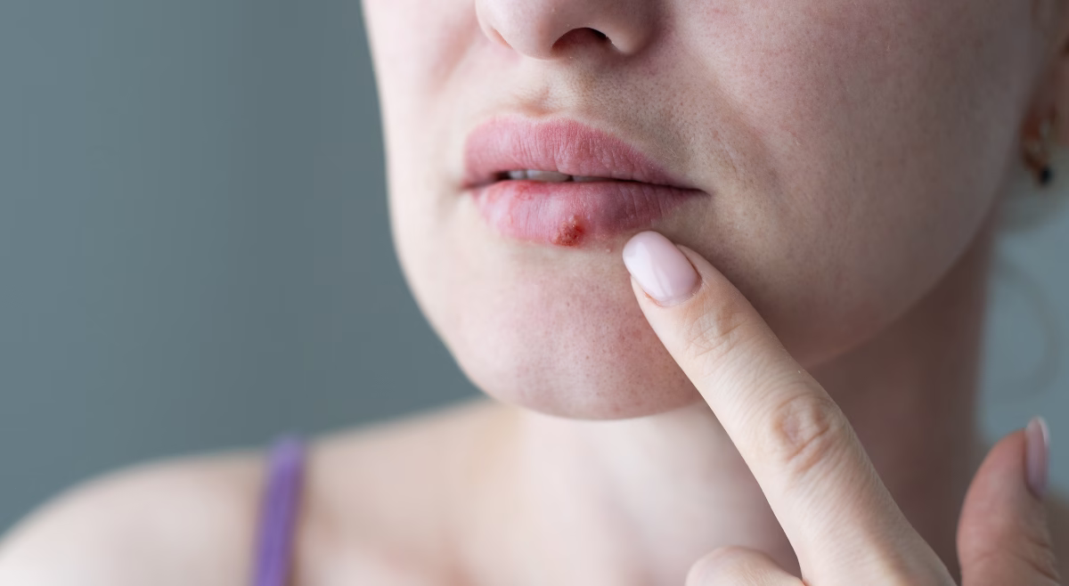 koortslip behandelen en voorkomen