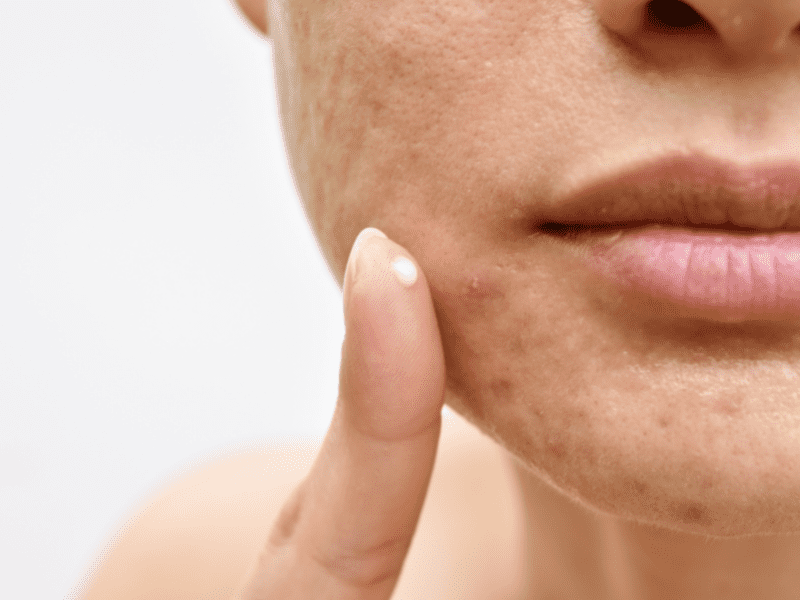 hormonale acne vormt zich vooral rondom de onderkant van het gezicht
